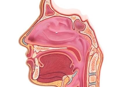 Cordectomie postérieure par voie endoscopique au laser chez l’enfant