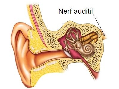 Neurinome de l’acoustique