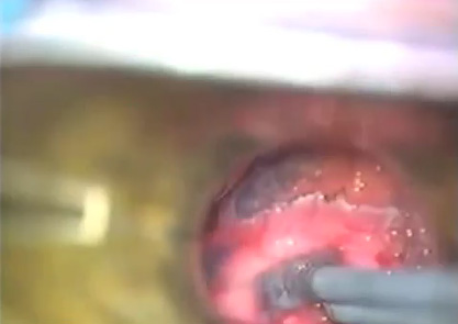 Laryngectomie partielle ou pharyngo-laryngectomie partielle