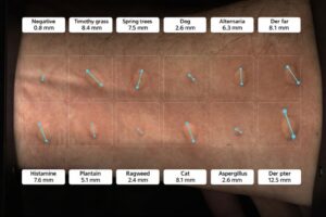 Résultats du test d'allergie