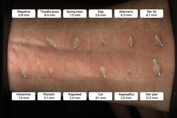 Nouveau système de détection des allergies