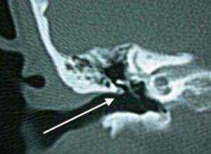 Illustration de l'article sur la chirurgie du cholestéatome