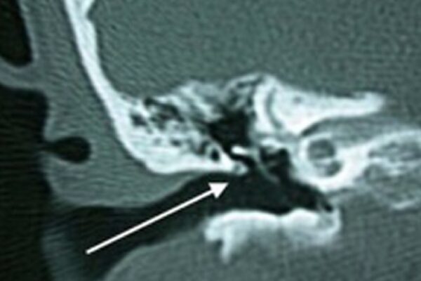 Utilisation de la chirurgie endoscopique de l’oreille dans la chirurgie du cholestéatome