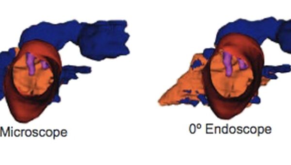Bases de la chirurgie endoscopique de l’oreille